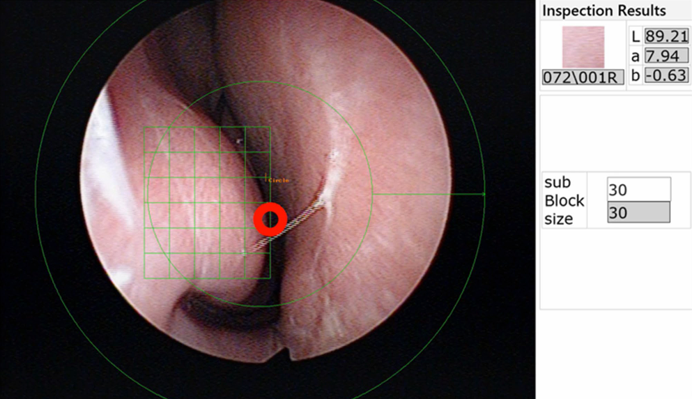 Allergic Rhinitis thumbnail
